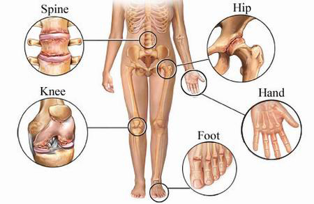 Arthritis osteoarthritis